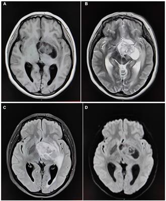 Efficacy evaluation of contrast-enhanced magnetic resonance imaging in differentiating glioma from metastatic tumor of the brain and exploration of its association with patients’ neurological function